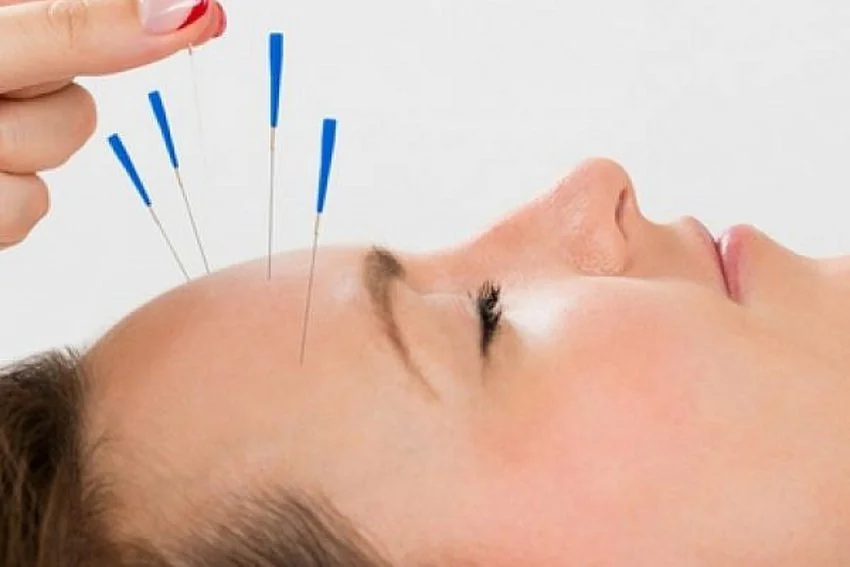 Иглорефлексотерапия в ЦСМ